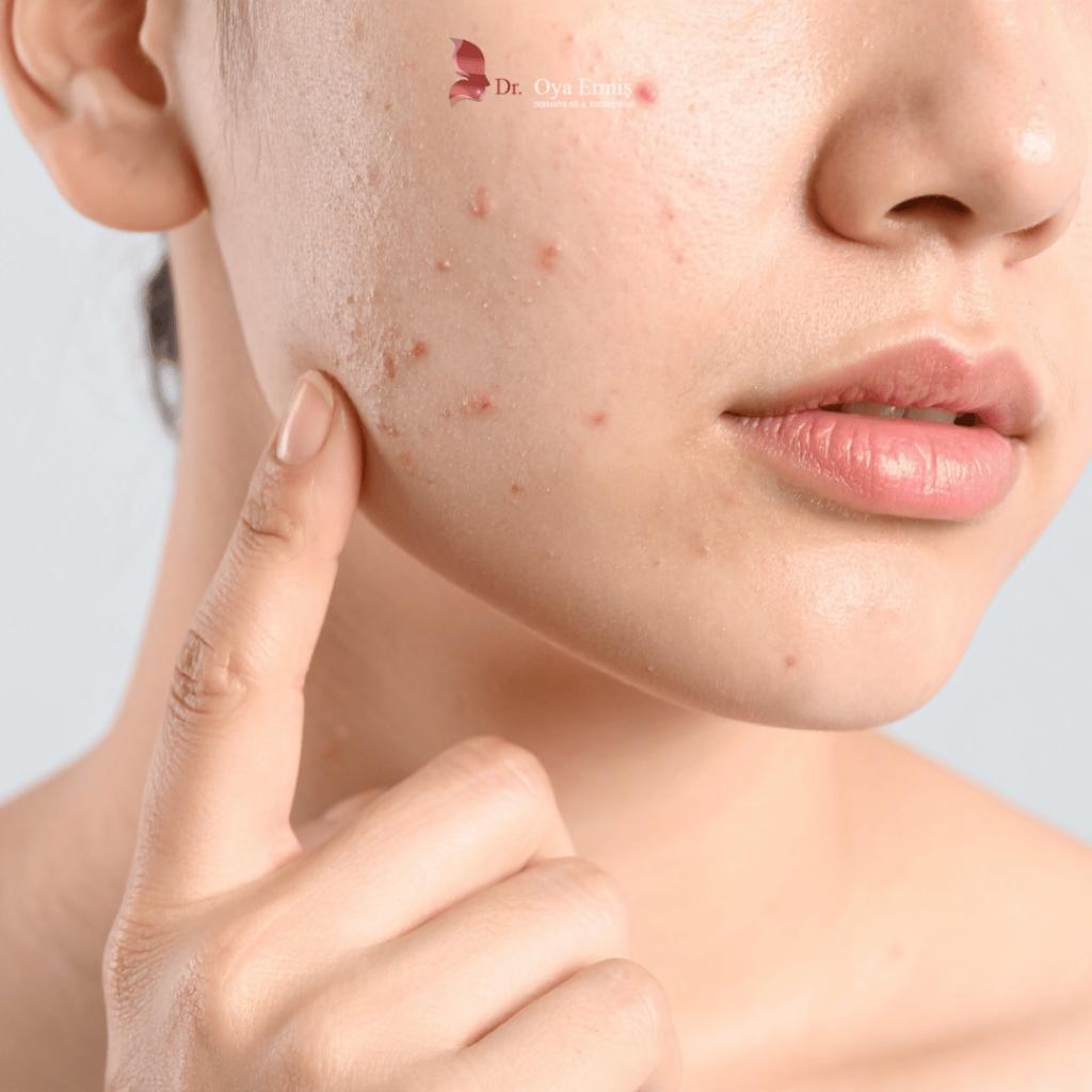 Altın İğne (Radyofrekans) Tedavisi ile Gözenek Sıkılaştırma ve Leke Giderme