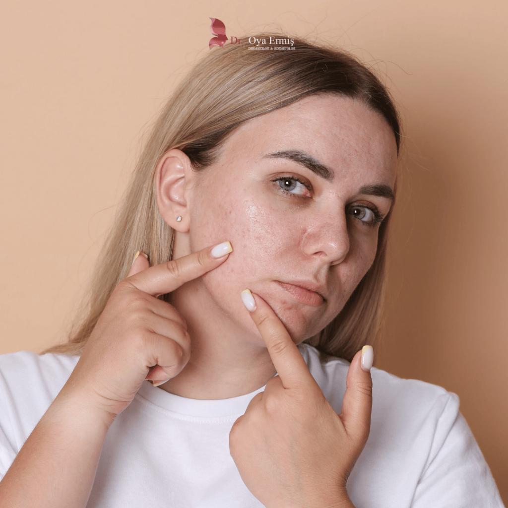 Güneş ve Doğum Lekelerine Son: Leke Tedavisinde Lazer ve Peeling Uygulamaları