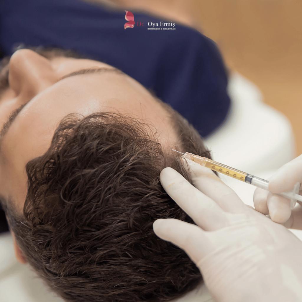 Saç Dökülmesine Karşı PRP ve Mezoterapi: Hangisi Sizin İçin Uygun?